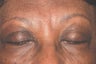 Botox
