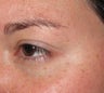 Botox