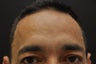 Botox to forehead and glabella