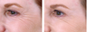 Botox Cosmetic