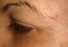 Botox