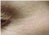 Botox