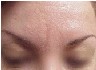 Botox