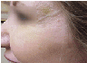 Botox