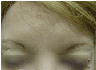 Botox