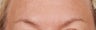 Botox