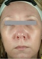 Botox