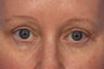 Botox to Crows Feet and Between Eyes (Glabella)