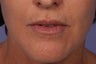 Botox and Juvederm Ultra Plus to Upper Lip