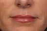 Botox 