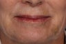 Botox and Juvederm 