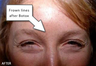 Botox - Glabella