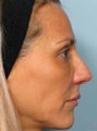BOTOX combined with Radiesse