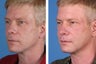 Radiesse, Restylane, Juvederm Plus & Botox Cosmetic