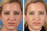 Botox Cosmetic & Restylane