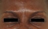 Botox