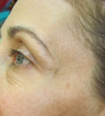 Botox