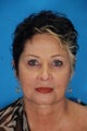 Botox and Juvederm