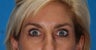 Botox