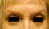 Botox & Restylane - Glabella 