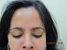 Botox for Frown Lines