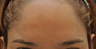 Botox