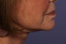 Botox to Neck (Platysmal Band Muscles)