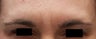 Frown Lines