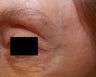Crow's feet wrinkles