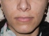 Botox Jawline Reduction
