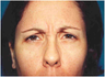 Botox