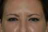 Botox injected in between the eyebrows and into the forehead
