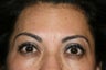 Botox