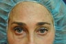 Botox