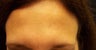 Botox Injections