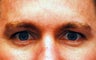 Botox Treatment of the Glabella ( 11s ) 