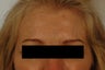 Coreecting Asymmetry with Botox (Dysport Browlift). 