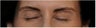 Botox