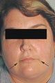 Botox and Restylane for Mouth Frown
