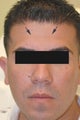 Botox treatment for forehead