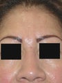 Botox for frown line (glabella) 