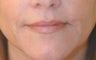 Lip enhancement (smoker's lines)