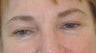 Botox forehead lines (frown lines) 