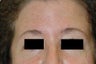 Botox for forehead lines