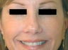 Botox for Crows Feet 