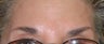 Botox Treatment for Forehead and Brow Wrinkles