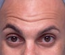 Cosmetic Microdroplet BOTOX® Treatment