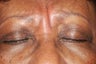 Botox