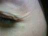 Botox