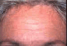 Botox